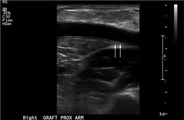 人工血管动静脉瘘正常声像图:二维矢状面超声显示上肢近段的人工血管