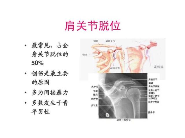 1,肩关节脱位复位后