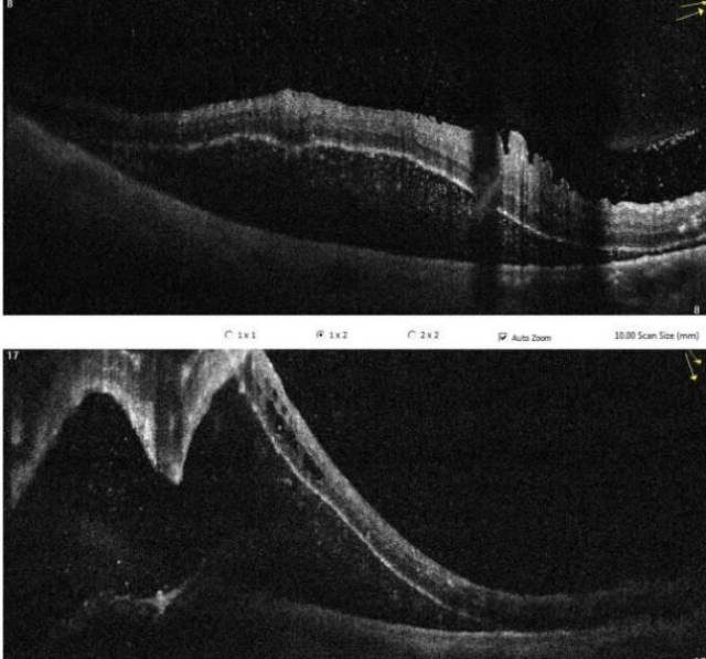黄斑oct:右眼黄斑水肿