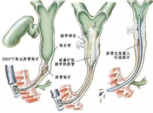 胆管,胰管狭窄扩张术;鼻胆管,鼻胰管引流术;胆管支架,胰管支架置入