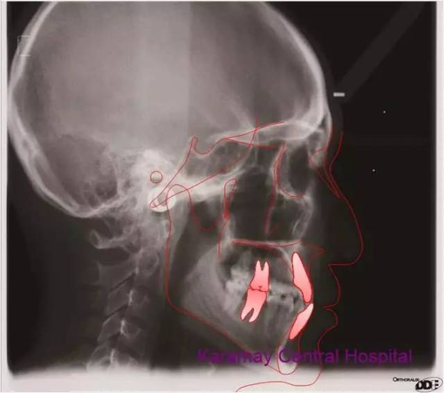 隐形矫治十强病例丨隐形矫治解决半侧反合伴下颌偏斜一例