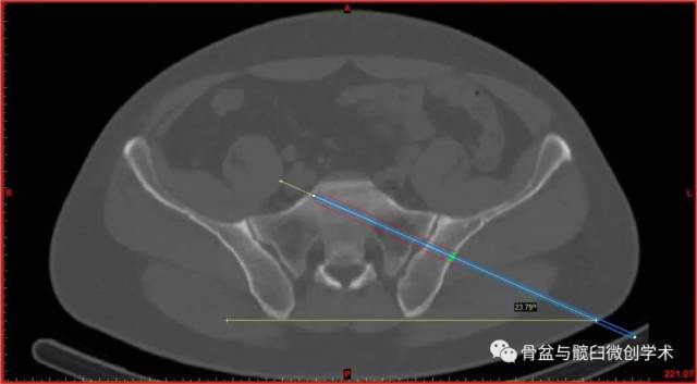 骶1骶髂关节螺钉导针指向调整方法的ct研究