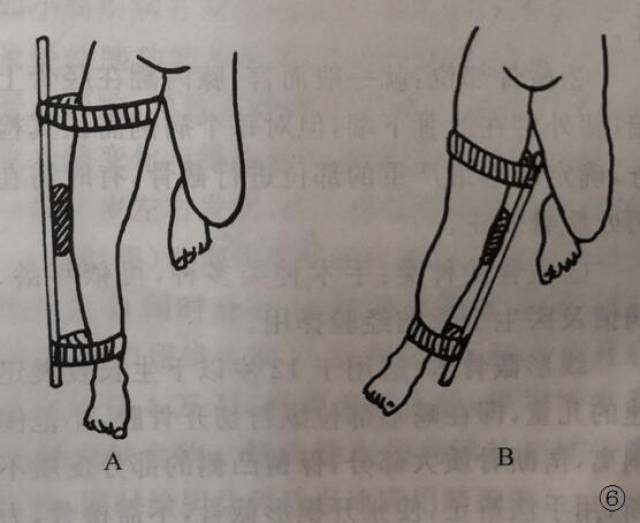 (一) 非手术矫正方法:其原理通过松弛膝关节内侧副韧带,恢复膝关节内