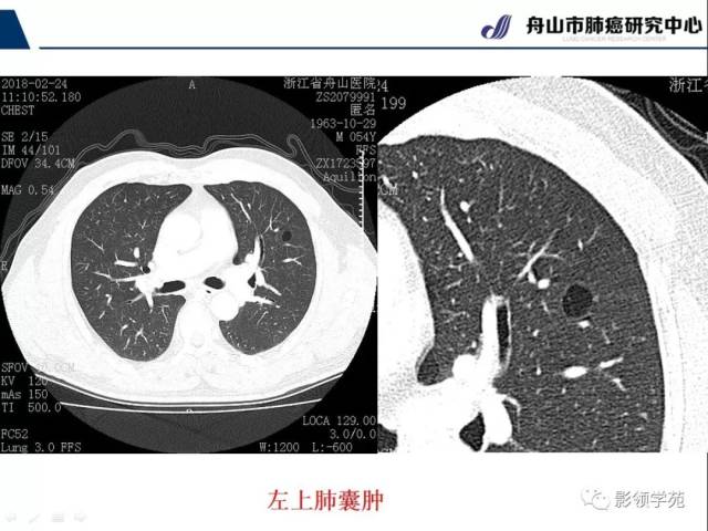 【经典课堂】早期周围型肺鳞癌ct诊断及鉴别诊断(上)