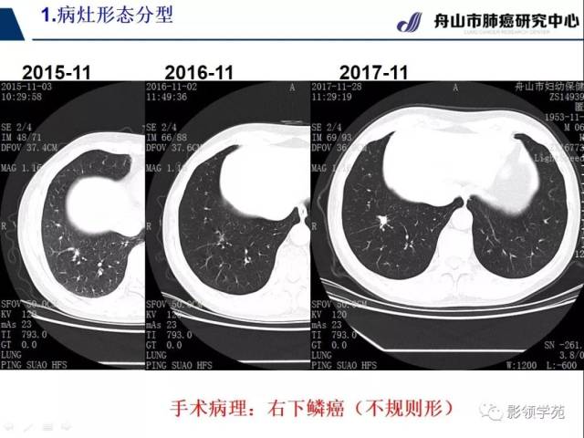 【经典课堂】早期周围型肺鳞癌ct诊断及鉴别诊断(上)