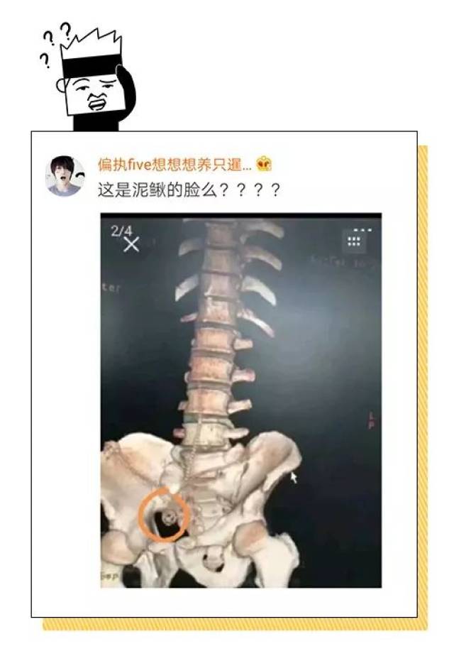 男子体内取出80cm长异物,x光片把医生看懵了