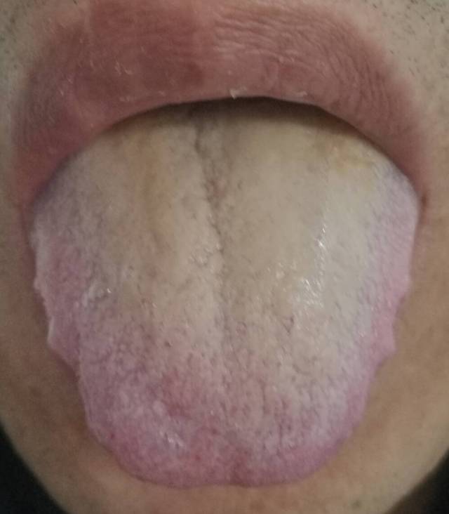 可怕的肾虚,从舌头就能看出来