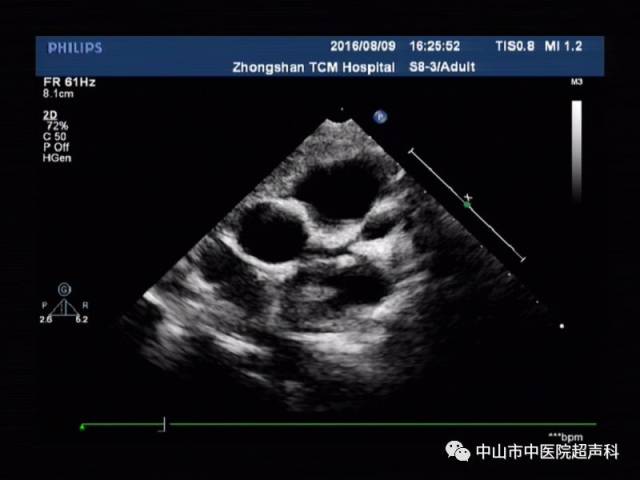不同种类的结构性先心病或后天性心脏病及非心源性疾病,诸如川崎病