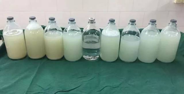 男子咳嗽3个月,洗肺洗出72瓶"牛奶"样液体……丨