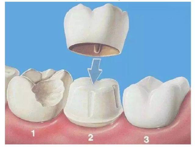 所以,根管治疗后的冠修复,就是在牙齿完整的基础上,更省钱的一种方式!