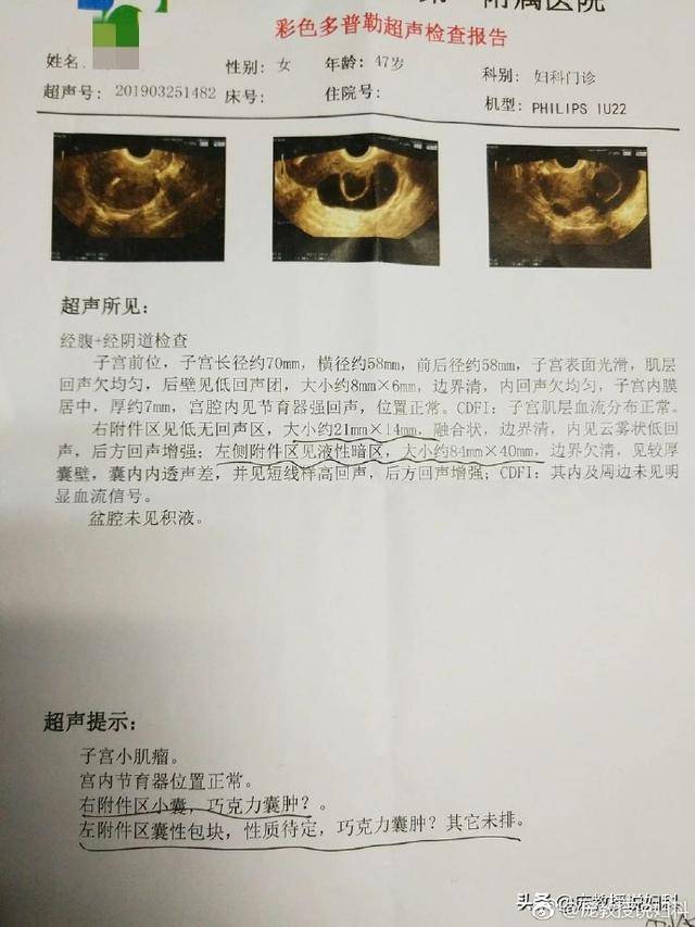 卵巢巧克力囊肿,到底是啥样,有什么症状?