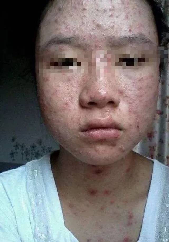 常见病毒感染性皮肤病科普(一):水痘