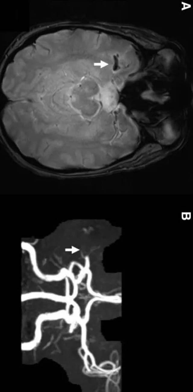 stroke:磁敏感征阳性的临床意义