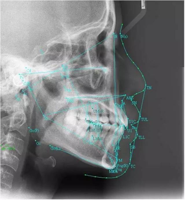 隐形矫治十强病例丨不对称拔牙矫治突面型一例