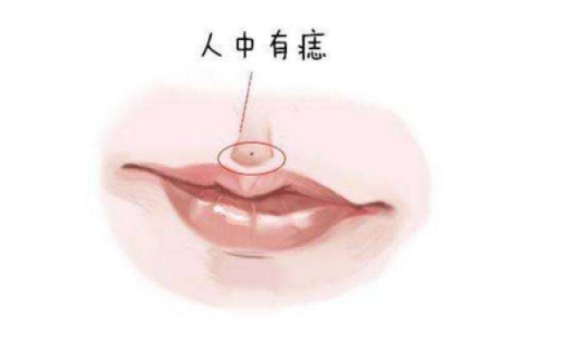 人中痣好不好 搜狐网