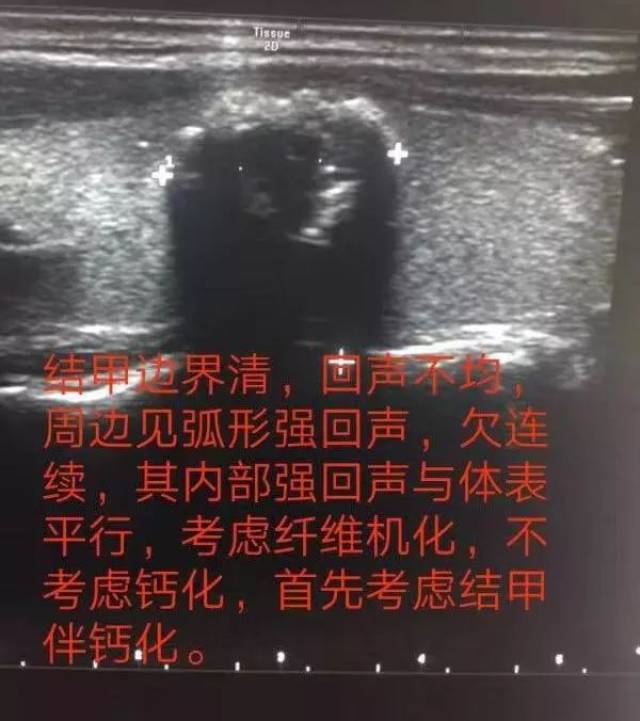 当"甲状腺结节"遇上"钙化,就是癌?