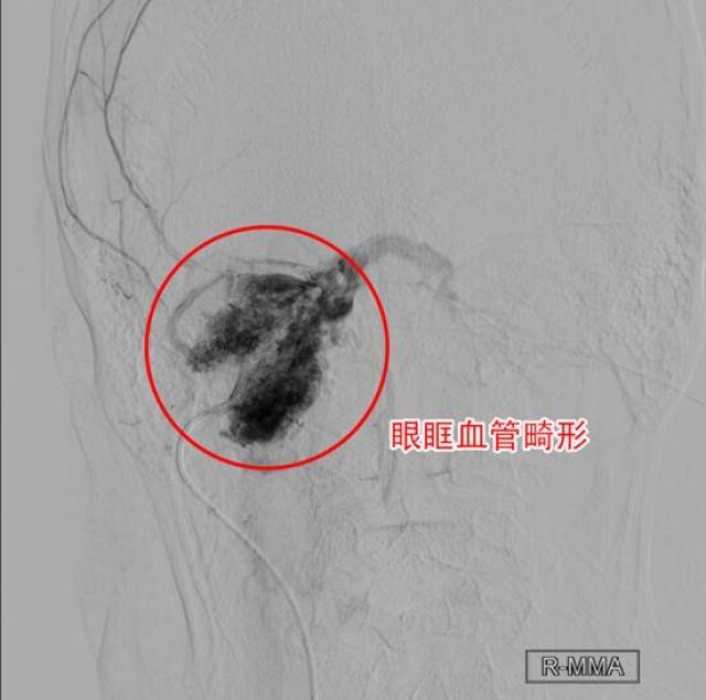 十年眼突又肿胀 原是血管畸形潜伏眼眶