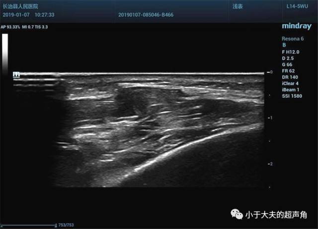 【超声】"误入歧途"的肌肉 - 肌疝