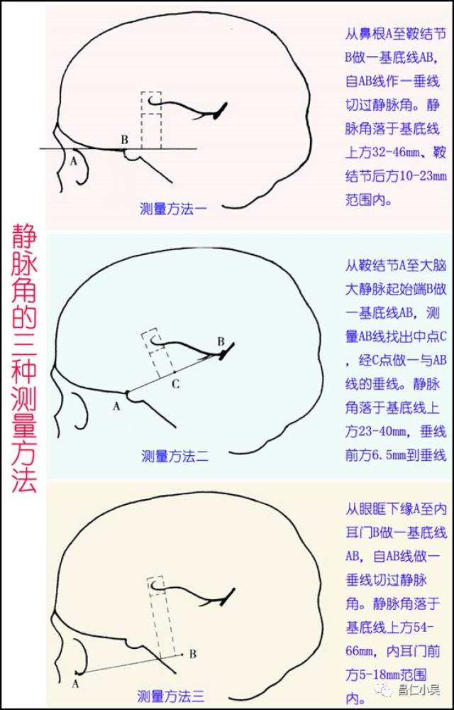 静脉角的前端标志着室间孔的后界.