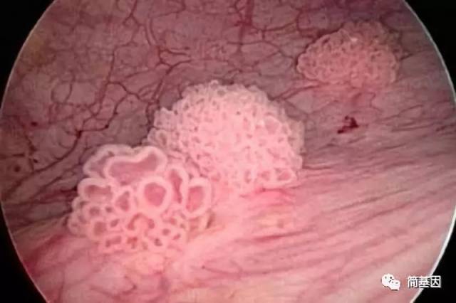 膀胱肿瘤形态像一朵花