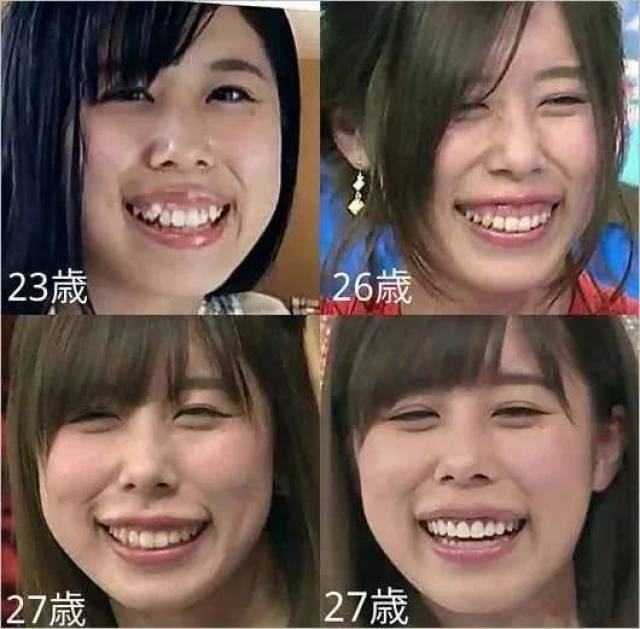 最终也是肉眼可见的牙齿越来越整齐,牙龈也不外露了.