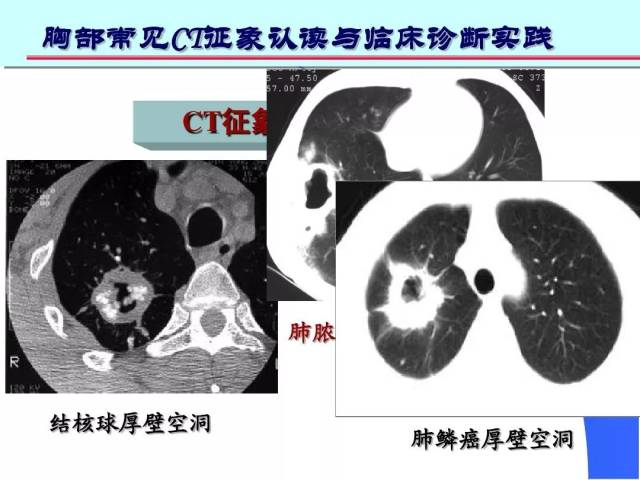 空洞(cavity)分型  虫蚀样空洞(无壁空洞)  薄壁空洞(≤3mm)  厚壁