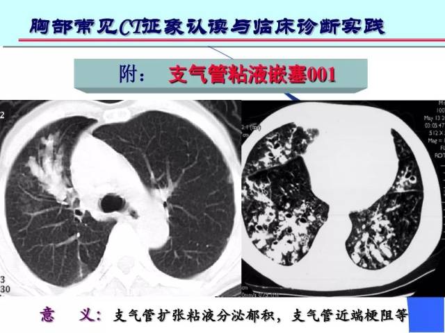 意义:表明有支气管扩张分泌粘液,支气管近端有梗阻 粘液不能排出而