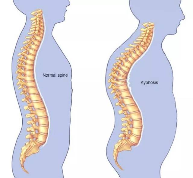 同样,腰椎曲度也是会发生改变的,腰椎曲度过大就会表现为s型翘臀曲线