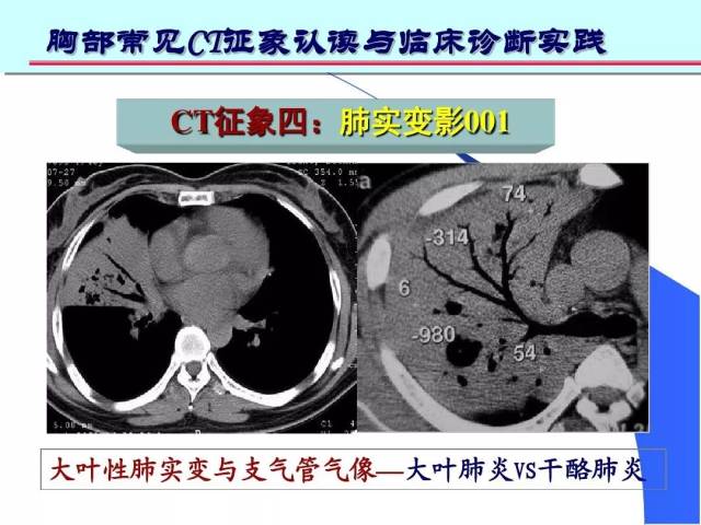 可见于:普通肺炎性疾病,肺结核,肺创伤,肺不张,肺肿瘤等. 小叶性肺实