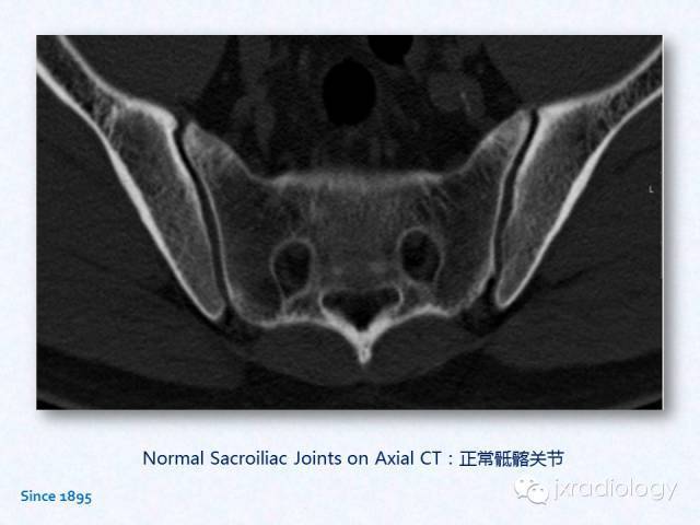 骶髂关节炎:x线,ct和mri表现