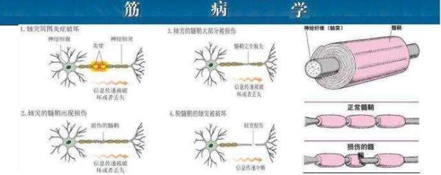 脑白质脱髓鞘会自愈吗?
