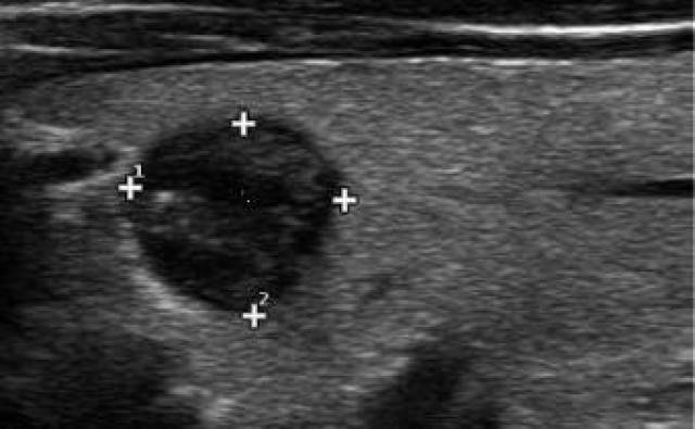 解读甲状腺结节超声报告,十六点就够了!
