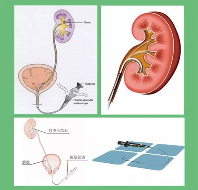 能屈能伸"的输尿管软镜碎石手术