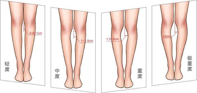 孩子o型腿难以解决少儿舞蹈培训帮你纠正