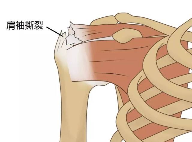 肩膀疼痛人群注意:肩膀疼不都是肩周炎,五个维度认识肩袖损伤