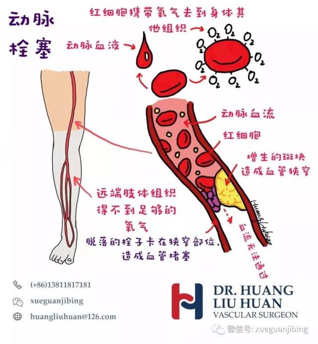 下肢动脉示意图和该病人的下肢动脉cta 黄柳桓医生绘图 什么是下肢