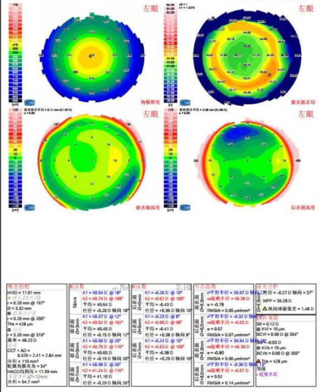 角膜地形图