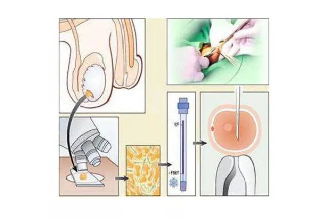 2 筛选精子dna碎片程度小的精子①睾丸穿刺术 从睾丸中直接获取的