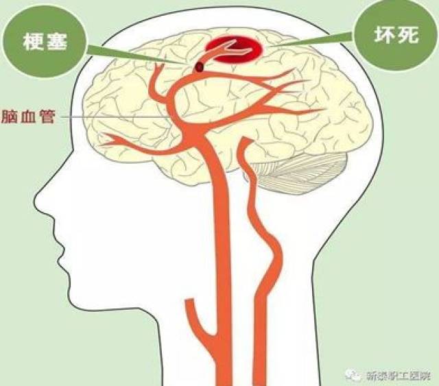 特点:发病率高,致残率高,死亡率高,复发率高,并发症多.