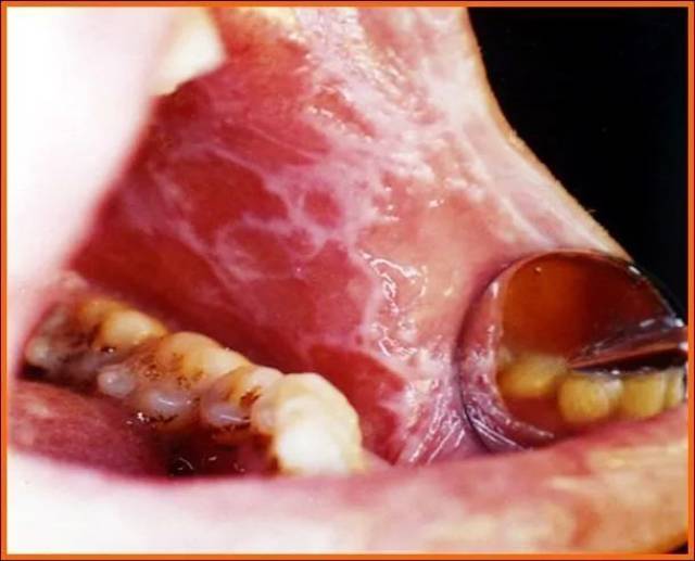 口腔粘膜病中的白斑,扁平苔藓等属于癌前病变,需要密切关注.