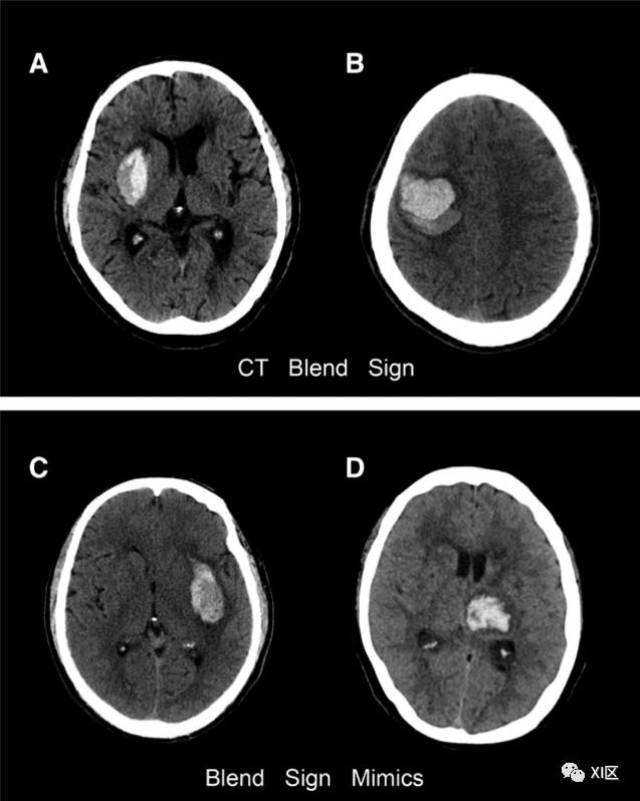ct图像中脑出血血肿扩大的十个征象(上)