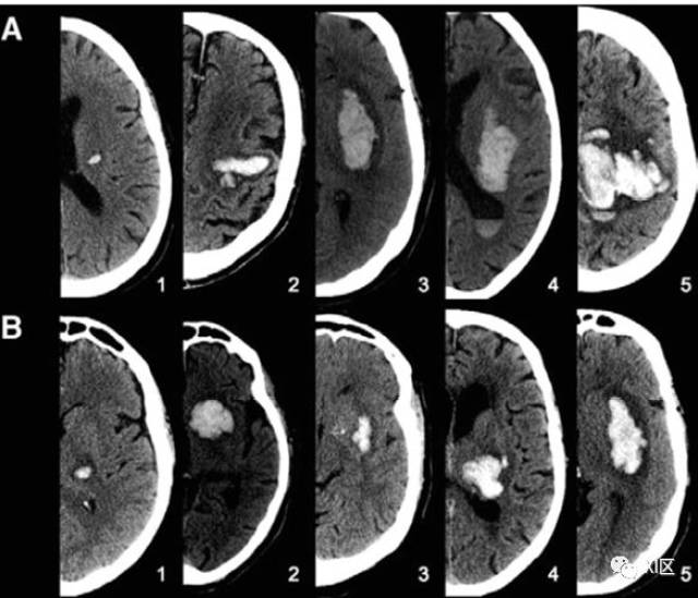 ct图像中脑出血血肿扩大的十个征象(上)
