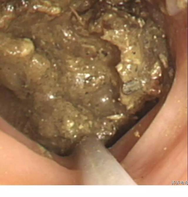 搬掉患者肠道内的拦路虎 —我院腔镜中心首例"粪石碎石术"喜获成功