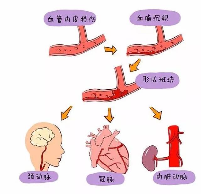 有了这些粥样斑块,就导致管腔越来越狭窄,水流量越来越少,以至于供水