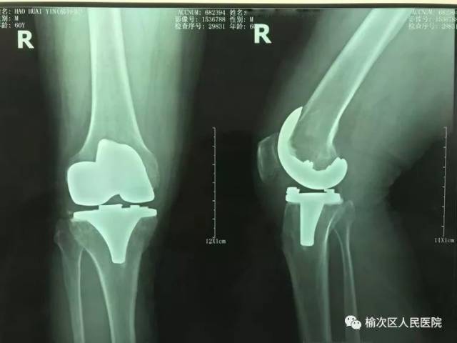 【医讯】榆次区人民医院骨一科成功开展榆次区首例膝关节"单髁置换术"