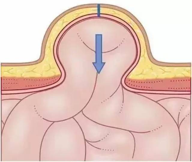 50岁以上男性朋友 若在腹股沟区突出一个包块 可得警惕一个叫 "疝气"