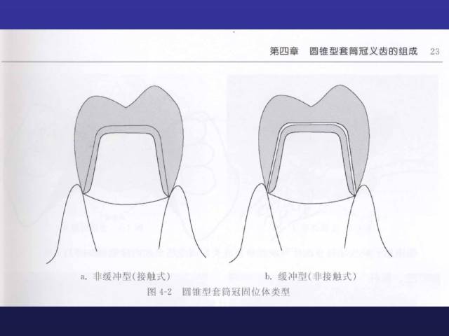 迪白口腔朱宏杰告诉你:什么叫套筒冠义齿?