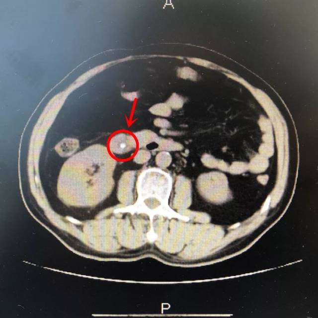 【关注前沿】患者腹痛难忍,ercp清除胆总管结石消除症状