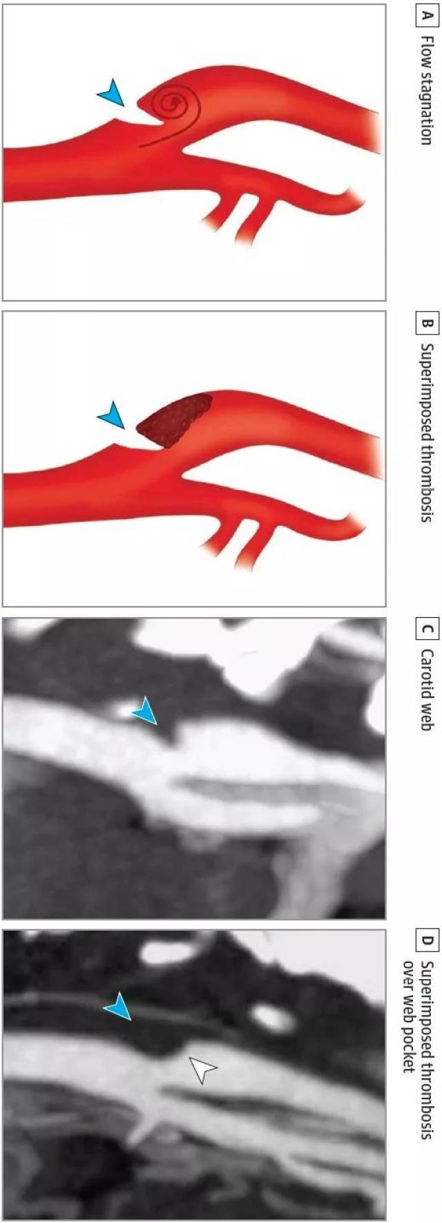 jama n:图解颈动脉蹼的影像学诊断