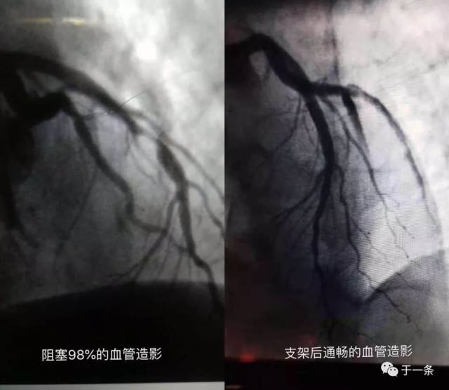 支架前后心脏造影对比